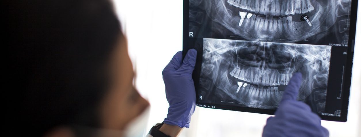 How to Choose the Right Dental Implant